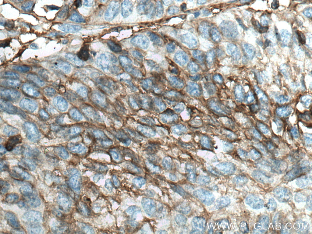 Immunohistochemistry (IHC) staining of human cervical cancer tissue using CD98/SLC3A2 Monoclonal antibody (66883-1-Ig)