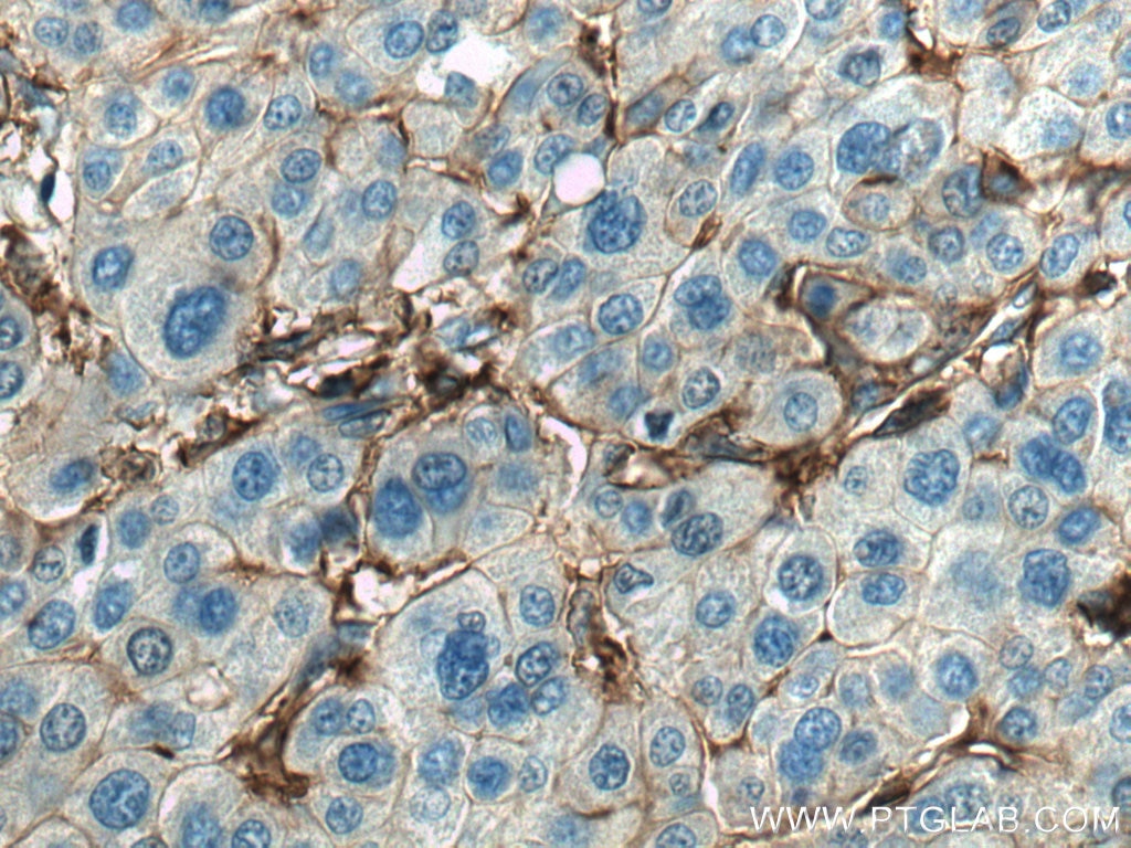Immunohistochemistry (IHC) staining of human liver cancer tissue using CD98/SLC3A2 Monoclonal antibody (66883-1-Ig)
