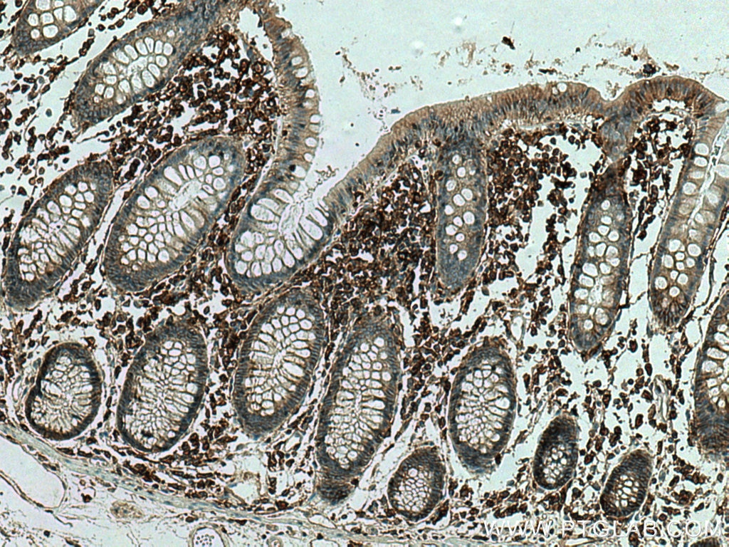 Immunohistochemistry (IHC) staining of human colon cancer tissue using CD98/SLC3A2 Monoclonal antibody (66883-1-Ig)