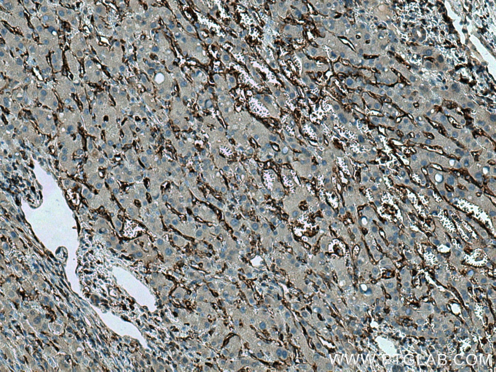 Immunohistochemistry (IHC) staining of human liver cancer tissue using CD98/SLC3A2 Monoclonal antibody (66883-1-Ig)
