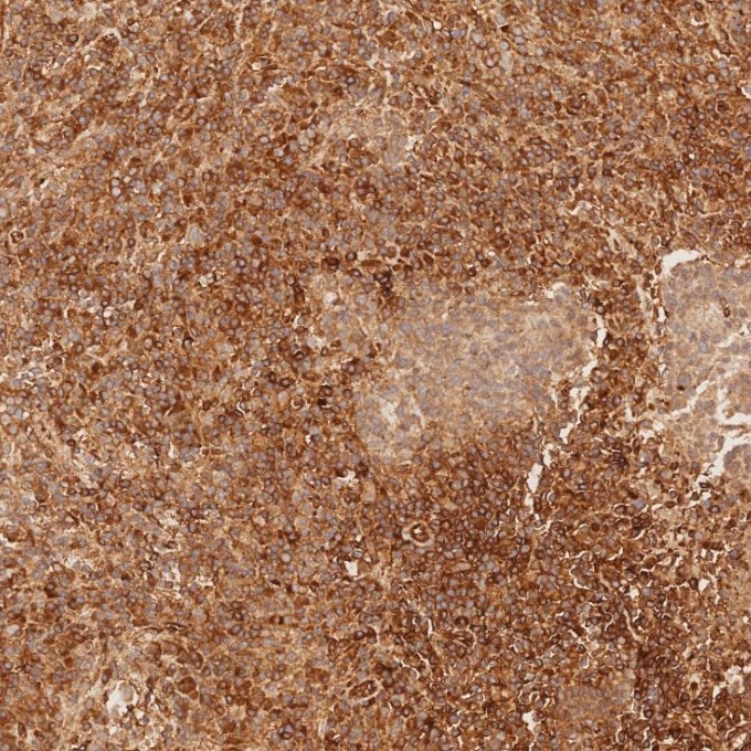 Immunohistochemistry (IHC) staining of human nasopharyngeal carcinoma tissue using CD99 Recombinant monoclonal antibody (84580-4-RR)