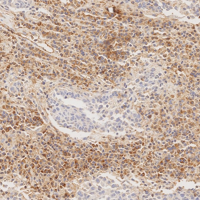 Immunohistochemistry (IHC) staining of human nasopharyngeal carcinoma tissue using CD99 Recombinant monoclonal antibody (84580-4-RR)