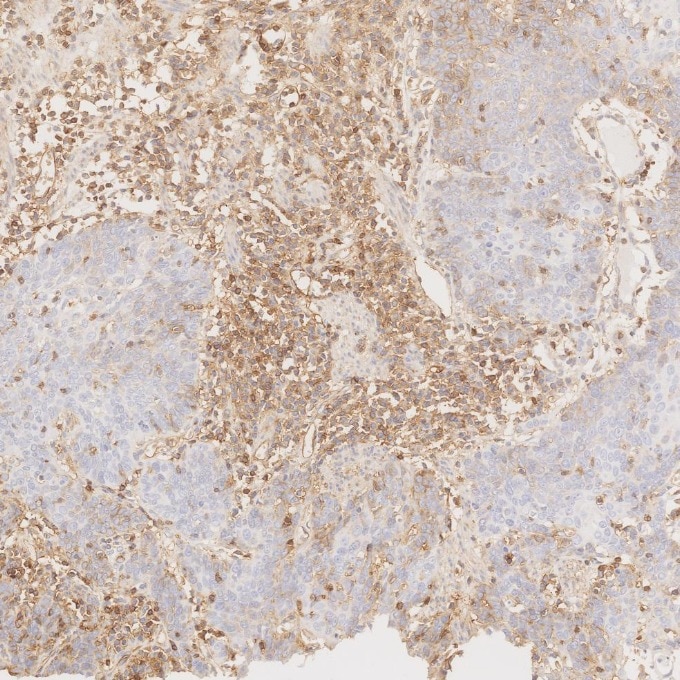 Immunohistochemistry (IHC) staining of human oesophagus cancer tissue using CD99 Recombinant monoclonal antibody (84580-4-RR)