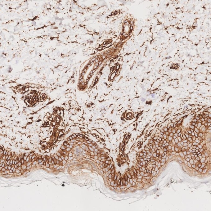 Immunohistochemistry (IHC) staining of human skin cancer tissue using CD99 Recombinant monoclonal antibody (84580-4-RR)