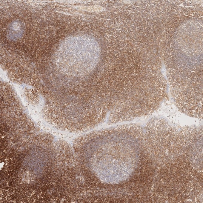 Immunohistochemistry (IHC) staining of human tonsillitis tissue using CD99 Recombinant monoclonal antibody (84580-4-RR)