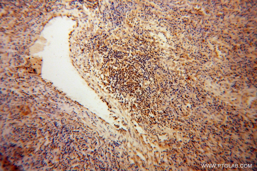 Immunohistochemistry (IHC) staining of human cervical cancer tissue using CDC16/APC6 Polyclonal antibody (14307-1-AP)