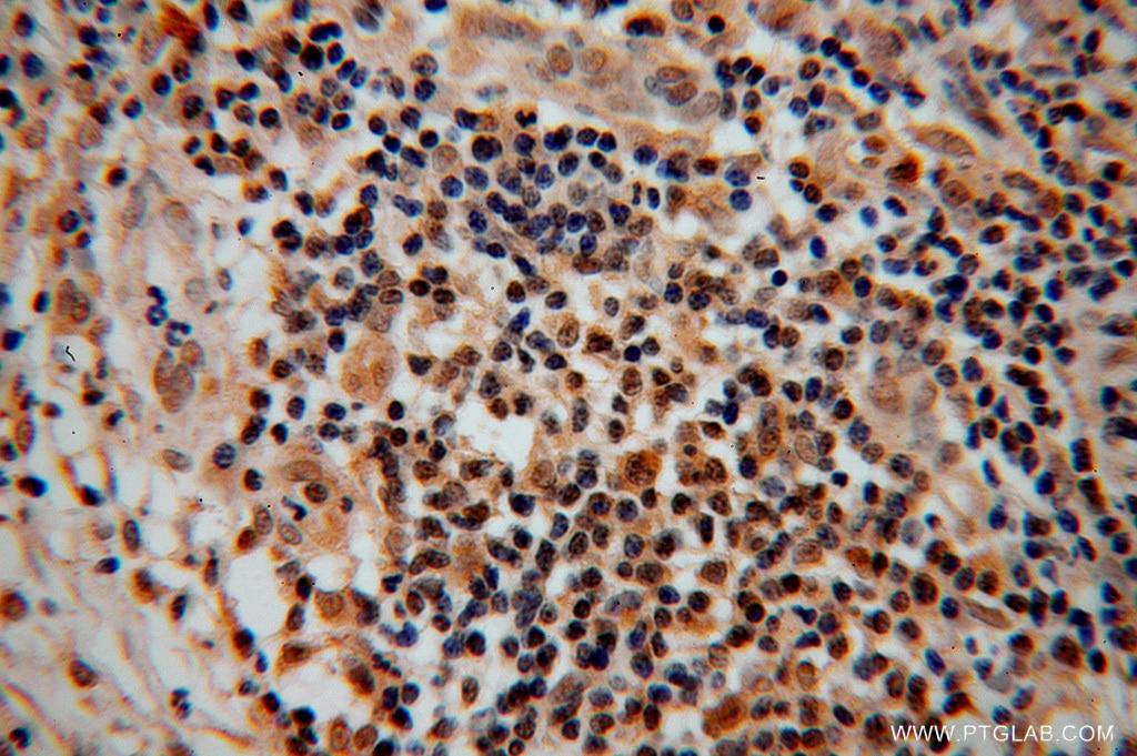 Immunohistochemistry (IHC) staining of human cervical cancer tissue using CDC16/APC6 Polyclonal antibody (14307-1-AP)