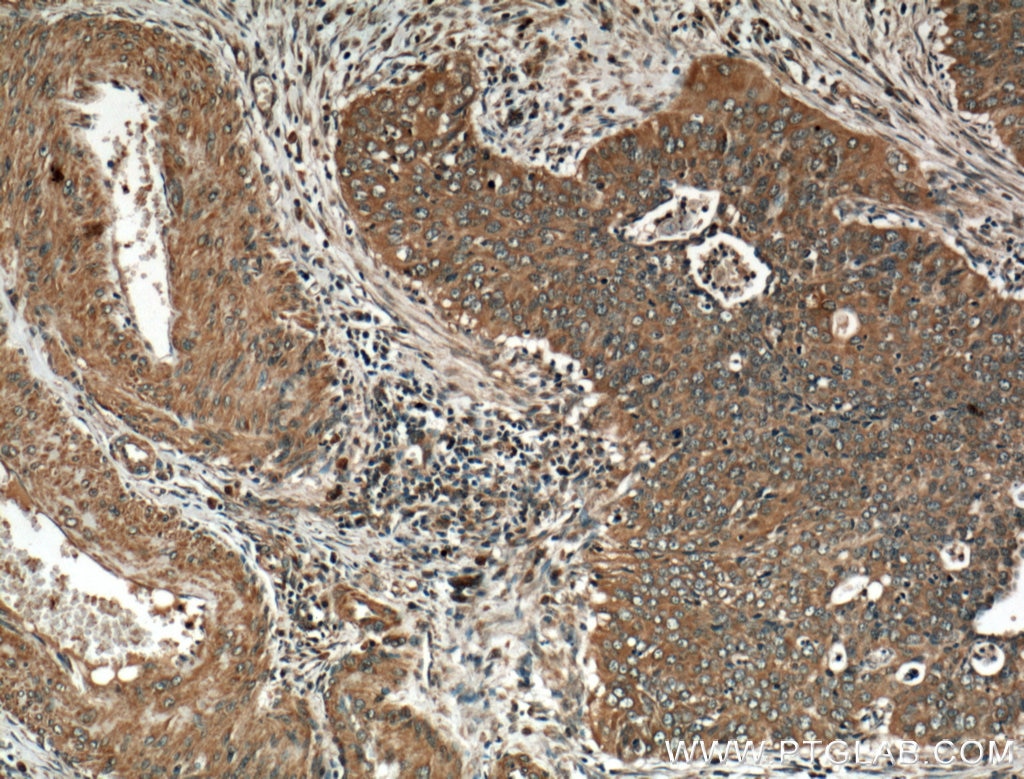 Immunohistochemistry (IHC) staining of human cervical cancer tissue using CDK1-Specific Polyclonal antibody (19532-1-AP)