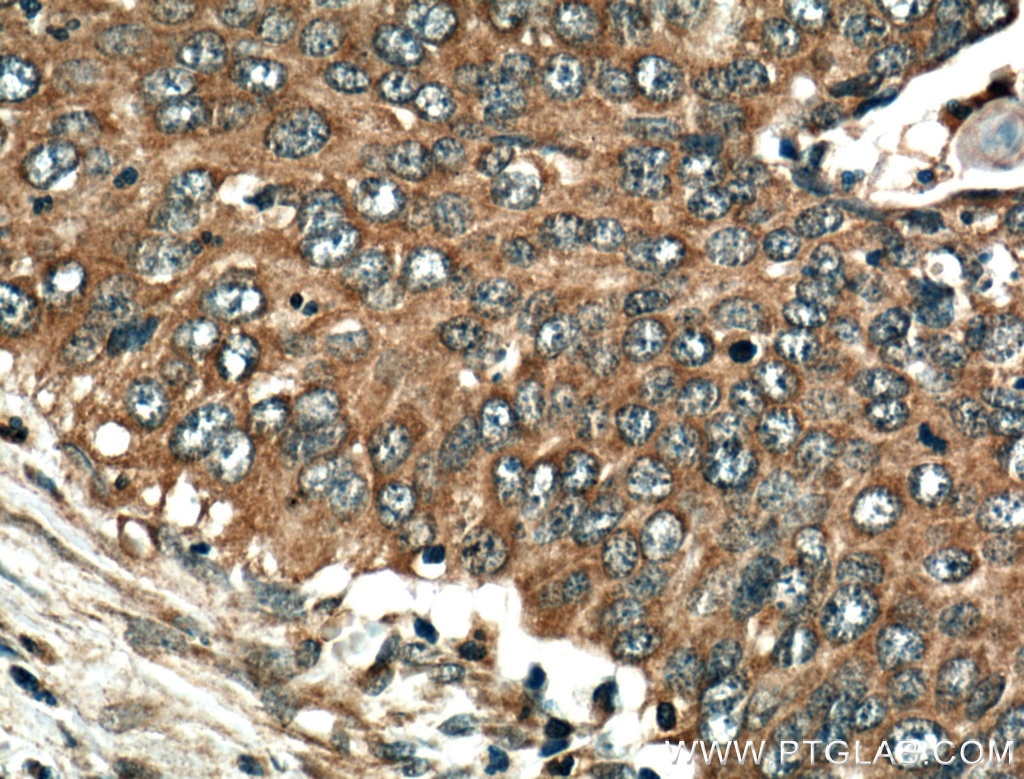 Immunohistochemistry (IHC) staining of human cervical cancer tissue using CDK1-Specific Polyclonal antibody (19532-1-AP)