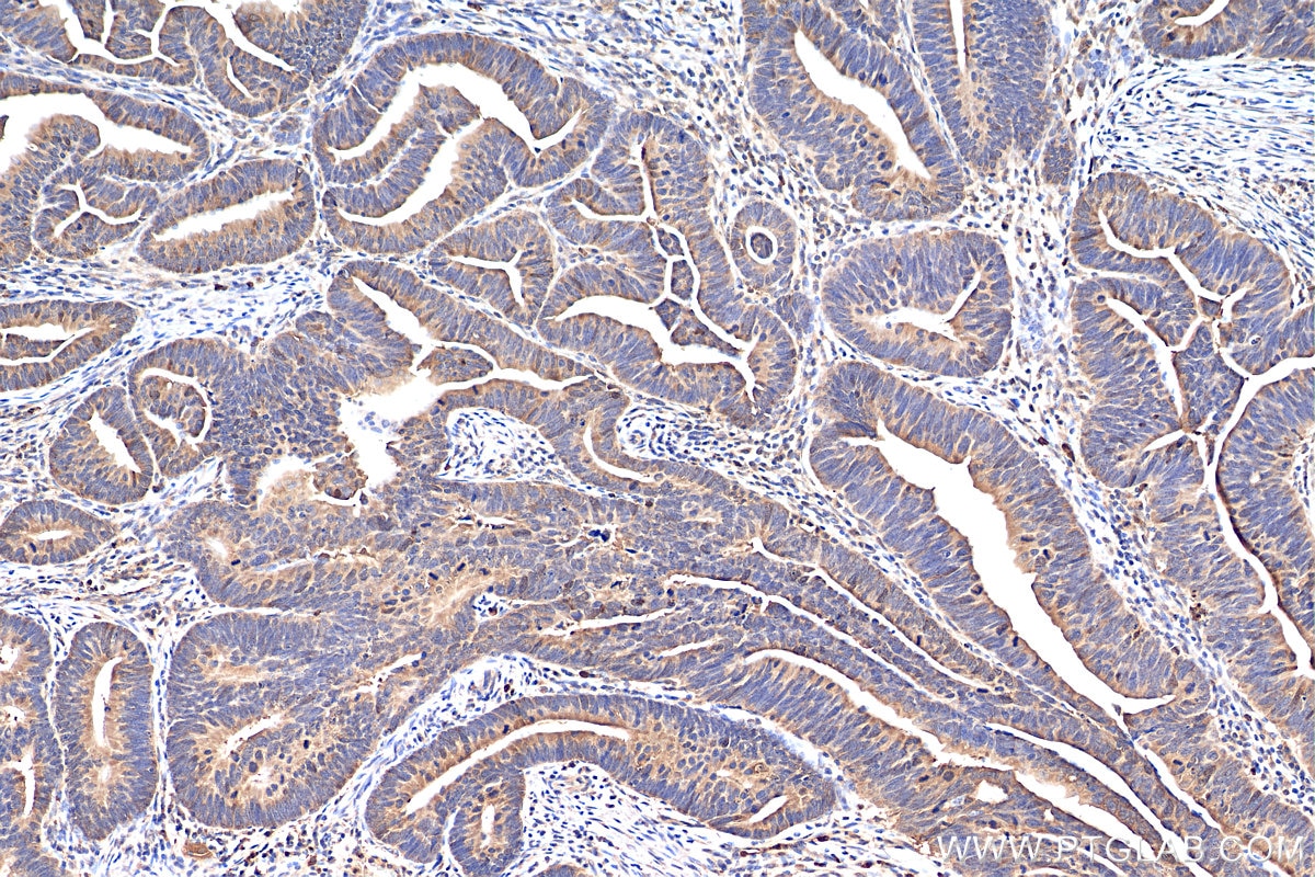 Immunohistochemistry (IHC) staining of human colon cancer tissue using Cdc20 Polyclonal antibody (10252-1-AP)