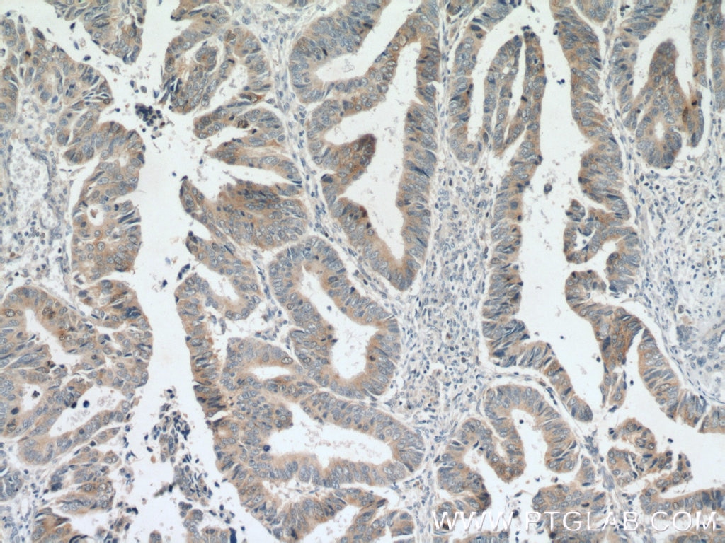 Immunohistochemistry (IHC) staining of human colon cancer tissue using Cdc20 Polyclonal antibody (10252-1-AP)