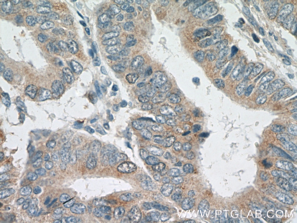 Immunohistochemistry (IHC) staining of human colon cancer tissue using Cdc20 Polyclonal antibody (10252-1-AP)