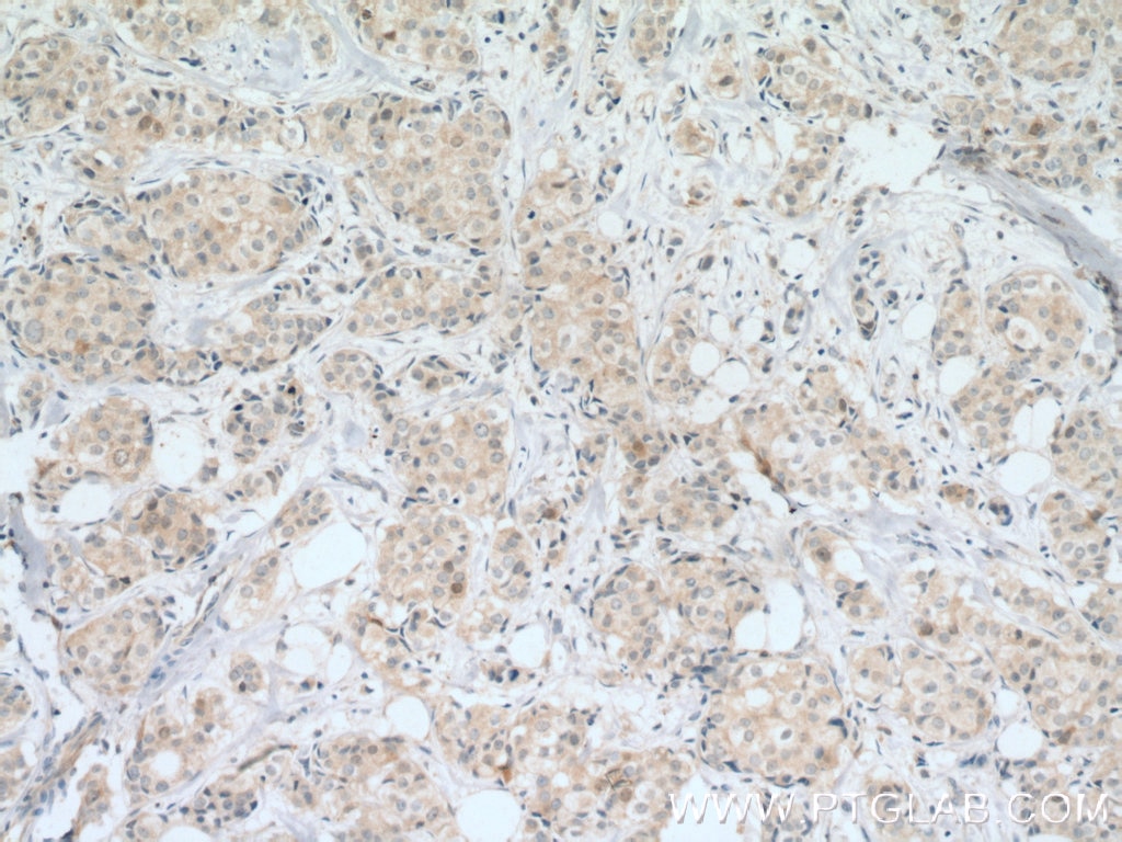 Immunohistochemistry (IHC) staining of human breast cancer tissue using Cdc20 Polyclonal antibody (10252-1-AP)