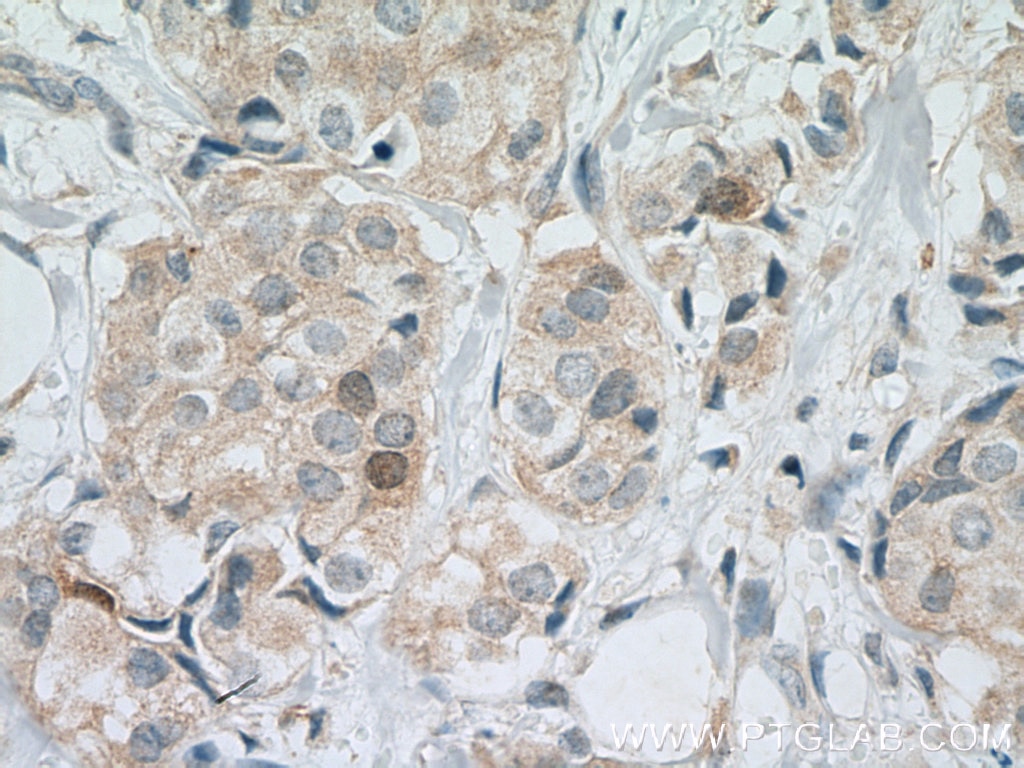 Immunohistochemistry (IHC) staining of human breast cancer tissue using Cdc20 Polyclonal antibody (10252-1-AP)