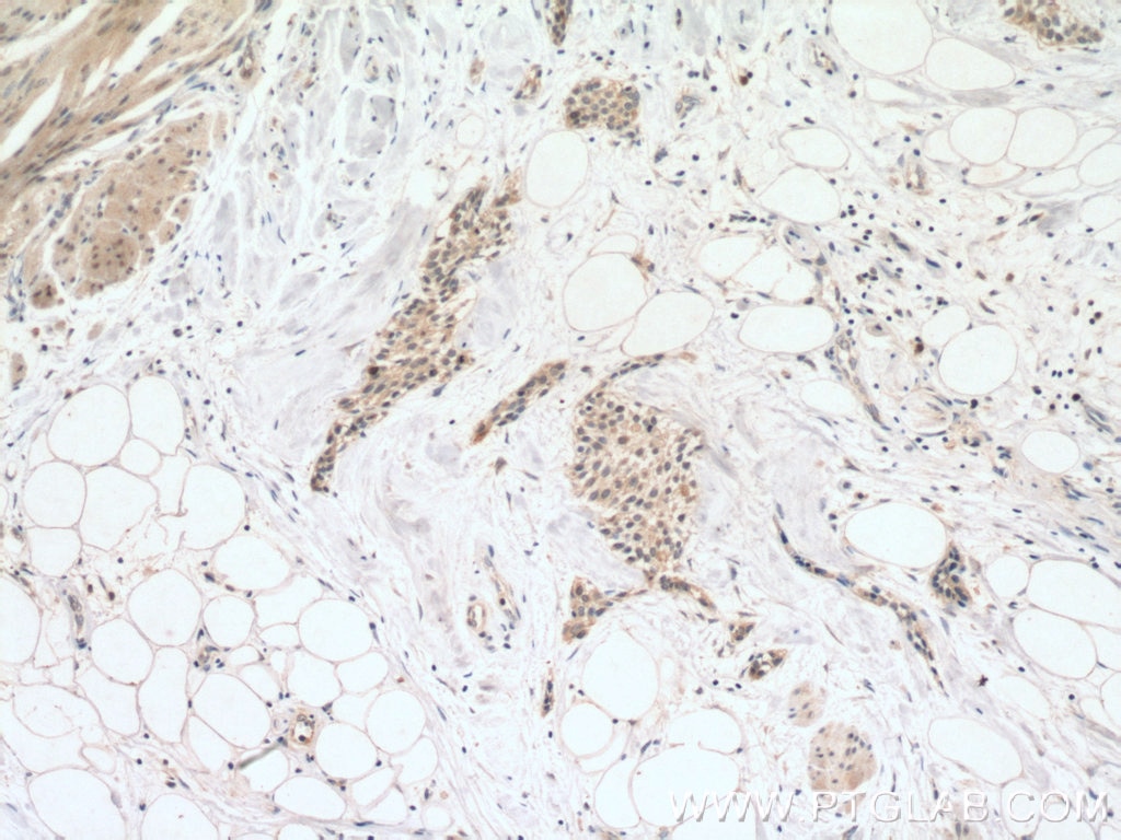 IHC staining of human urothelial carcinoma using 10252-1-AP