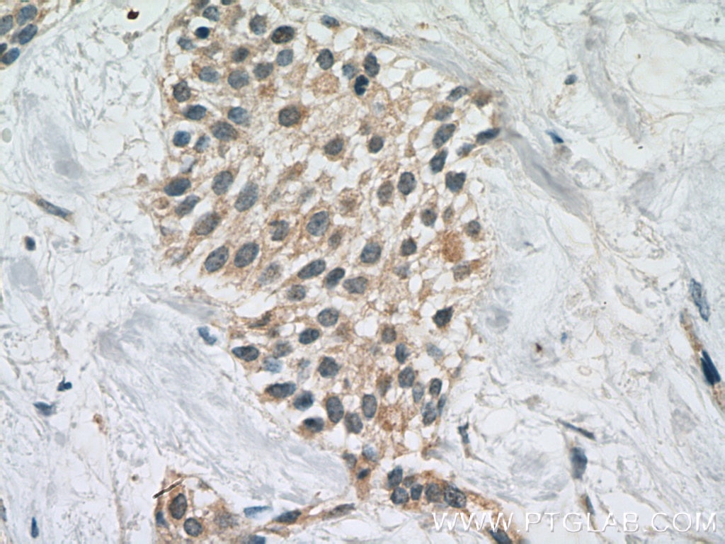 Immunohistochemistry (IHC) staining of human urothelial carcinoma tissue using Cdc20 Polyclonal antibody (10252-1-AP)