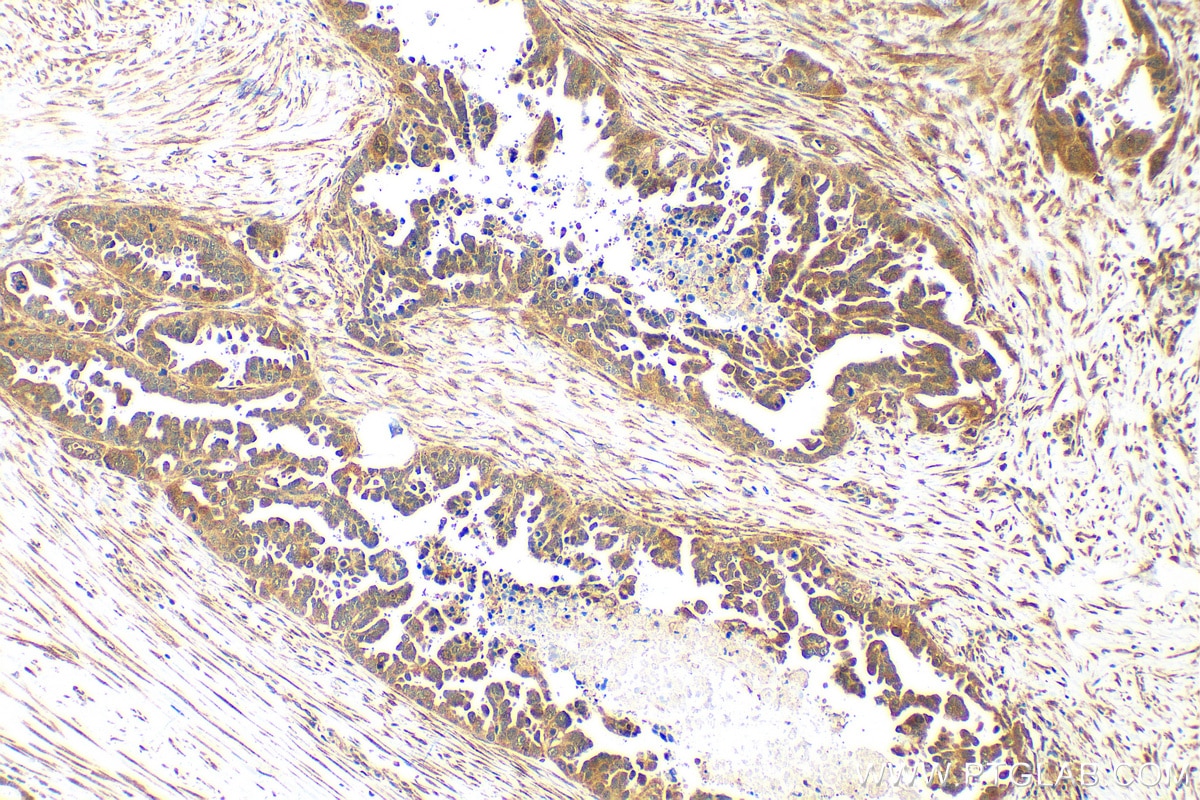 Immunohistochemistry (IHC) staining of human colon cancer tissue using CDC20 Polyclonal antibody (30451-1-AP)