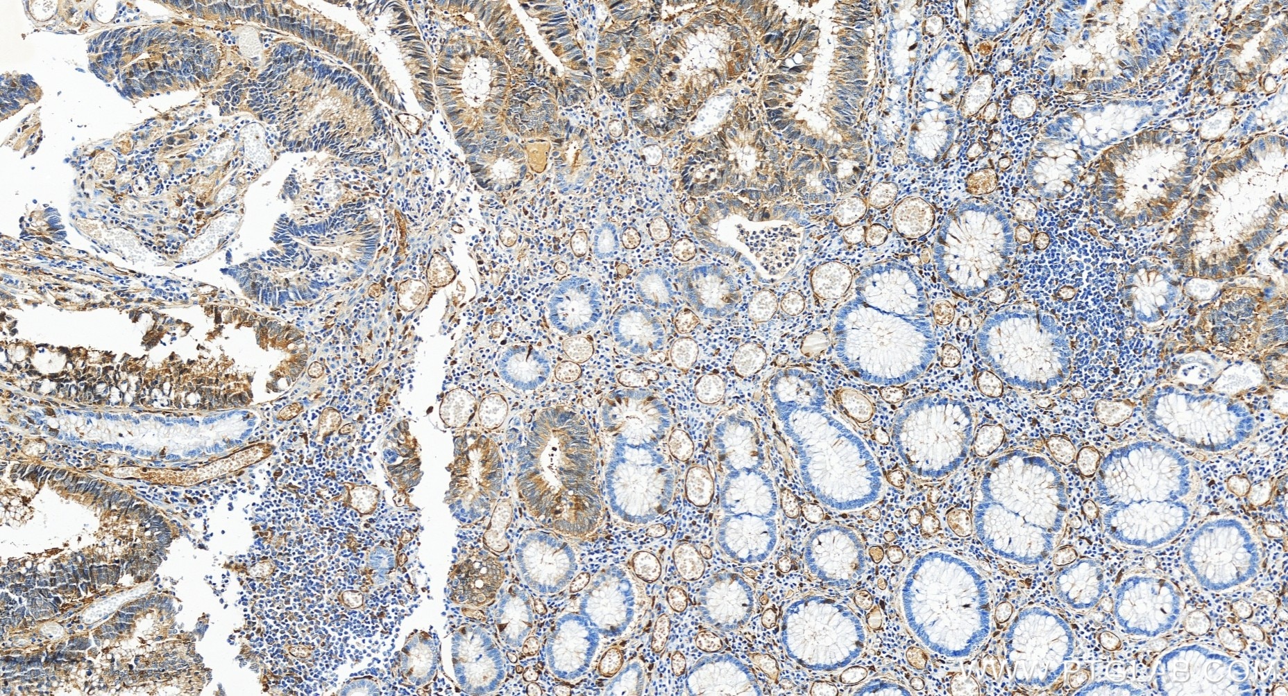 Immunohistochemistry (IHC) staining of human colon cancer tissue using CDC20 Recombinant antibody (84531-5-RR)