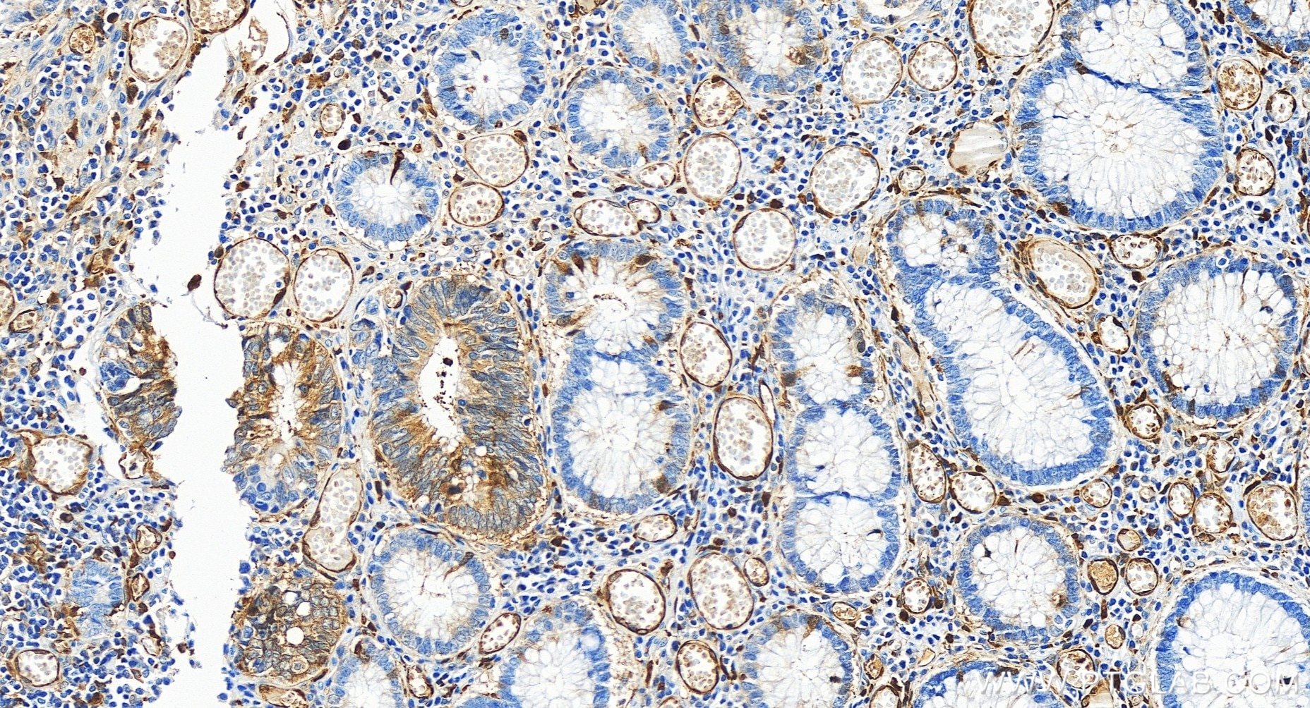Immunohistochemistry (IHC) staining of human colon cancer tissue using CDC20 Recombinant antibody (84531-5-RR)