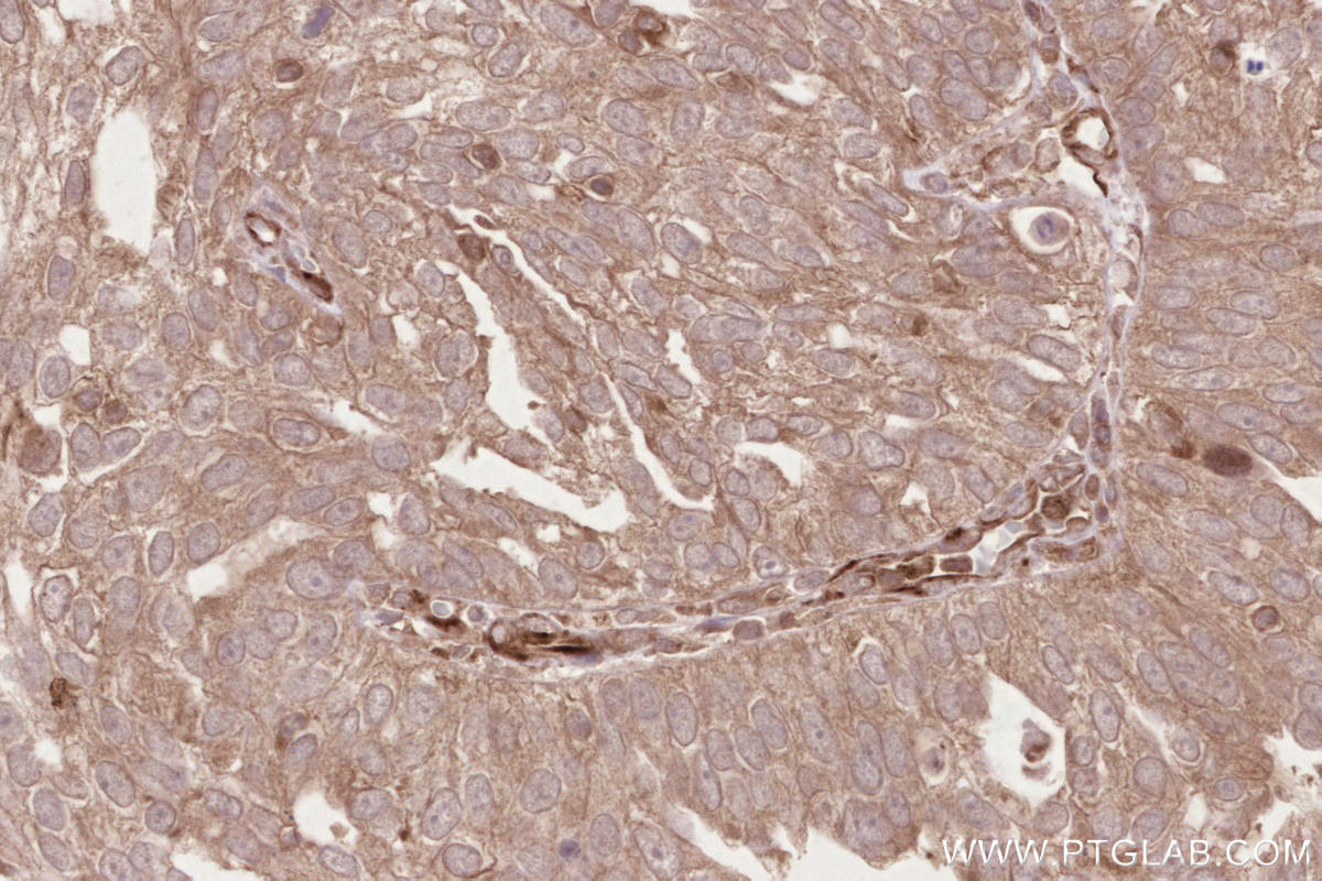 IHC staining of human ovary cancer using 13376-1-AP Immunohistochemistry (IHC) staining of human ovary cancer tissue using CDC20B Polyclonal antibody (13376-1-AP)