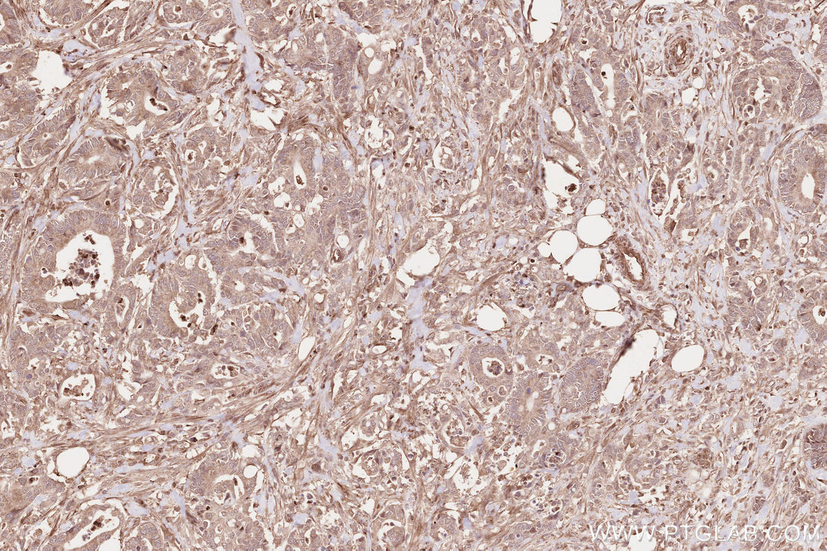 IHC staining of human rectal cancer using 13376-1-AP Immunohistochemistry (IHC) staining of human rectal cancer tissue using CDC20B Polyclonal antibody (13376-1-AP)