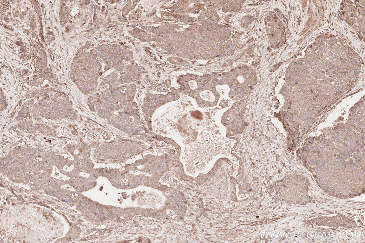 IHC staining of human stomach cancer using 13376-1-AP Immunohistochemistry (IHC) staining of human stomach cancer tissue using CDC20B Polyclonal antibody (13376-1-AP)