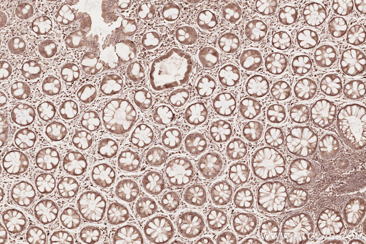 IHC staining of human rectal cancer using 13376-1-AP Immunohistochemistry (IHC) staining of human rectal cancer tissue using CDC20B Polyclonal antibody (13376-1-AP)