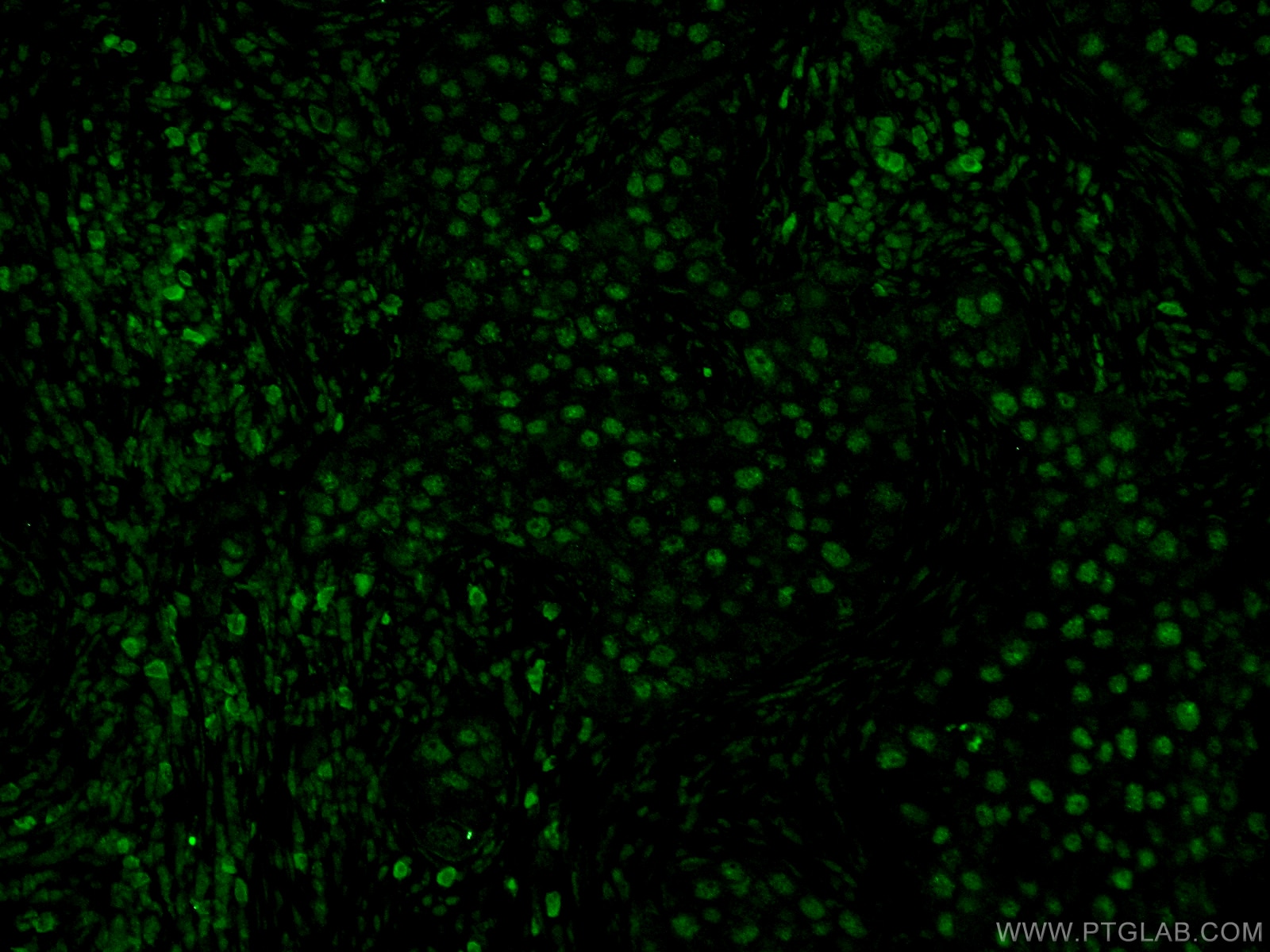 Immunofluorescence (IF) / fluorescent staining of human breast cancer tissue using CDC25A Polyclonal antibody (55031-1-AP)