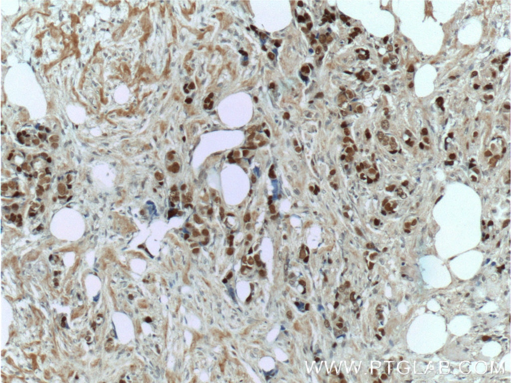 Immunohistochemistry (IHC) staining of human breast cancer tissue using CDC25A Polyclonal antibody (55031-1-AP)