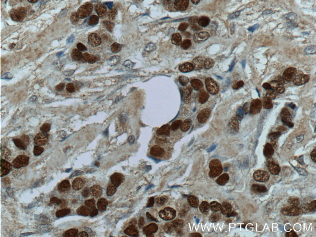 Immunohistochemistry (IHC) staining of human breast cancer tissue using CDC25A Polyclonal antibody (55031-1-AP)