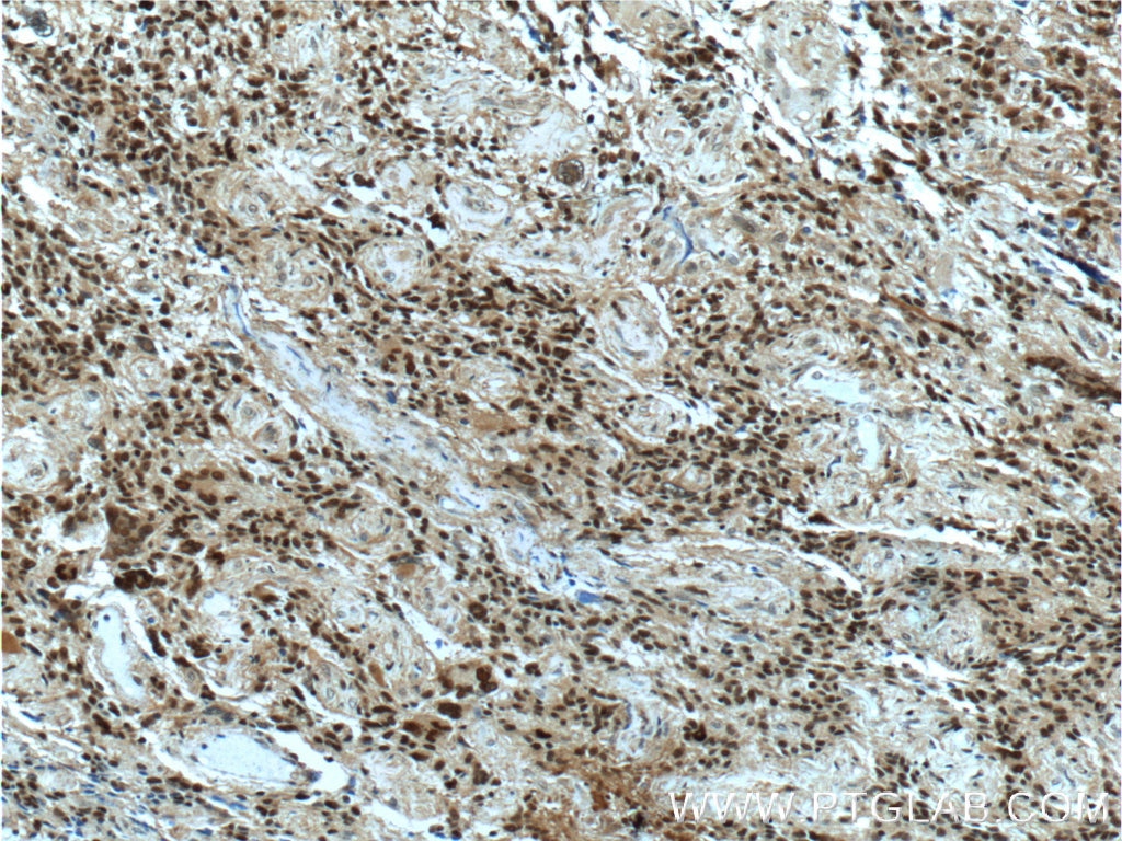 Immunohistochemistry (IHC) staining of human gliomas tissue using CDC25A Polyclonal antibody (55031-1-AP)