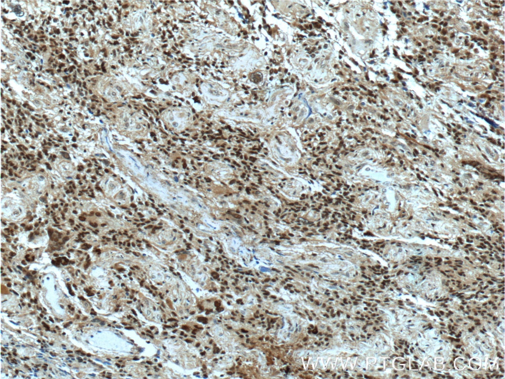 IHC staining of human gliomas using 55031-1-AP