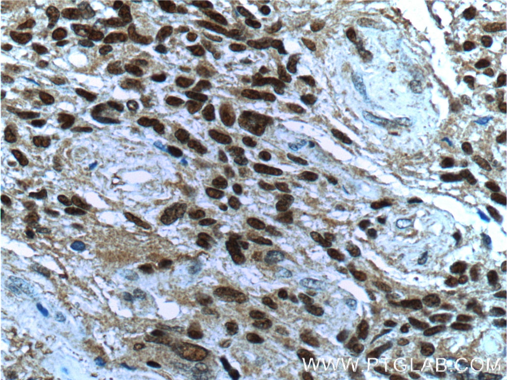 Immunohistochemistry (IHC) staining of human gliomas tissue using CDC25A Polyclonal antibody (55031-1-AP)