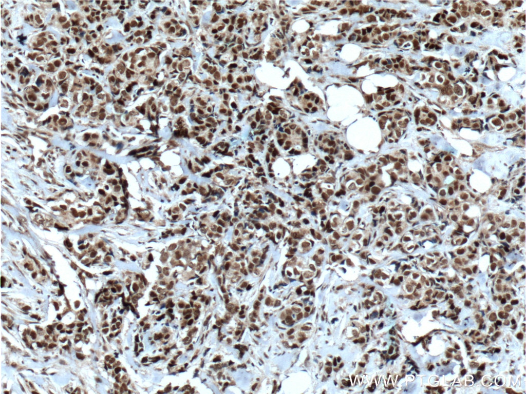 Immunohistochemistry (IHC) staining of human breast cancer tissue using CDC25A Polyclonal antibody (55031-1-AP)