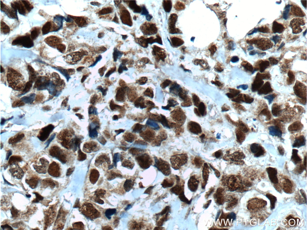 Immunohistochemistry (IHC) staining of human breast cancer tissue using CDC25A Polyclonal antibody (55031-1-AP)