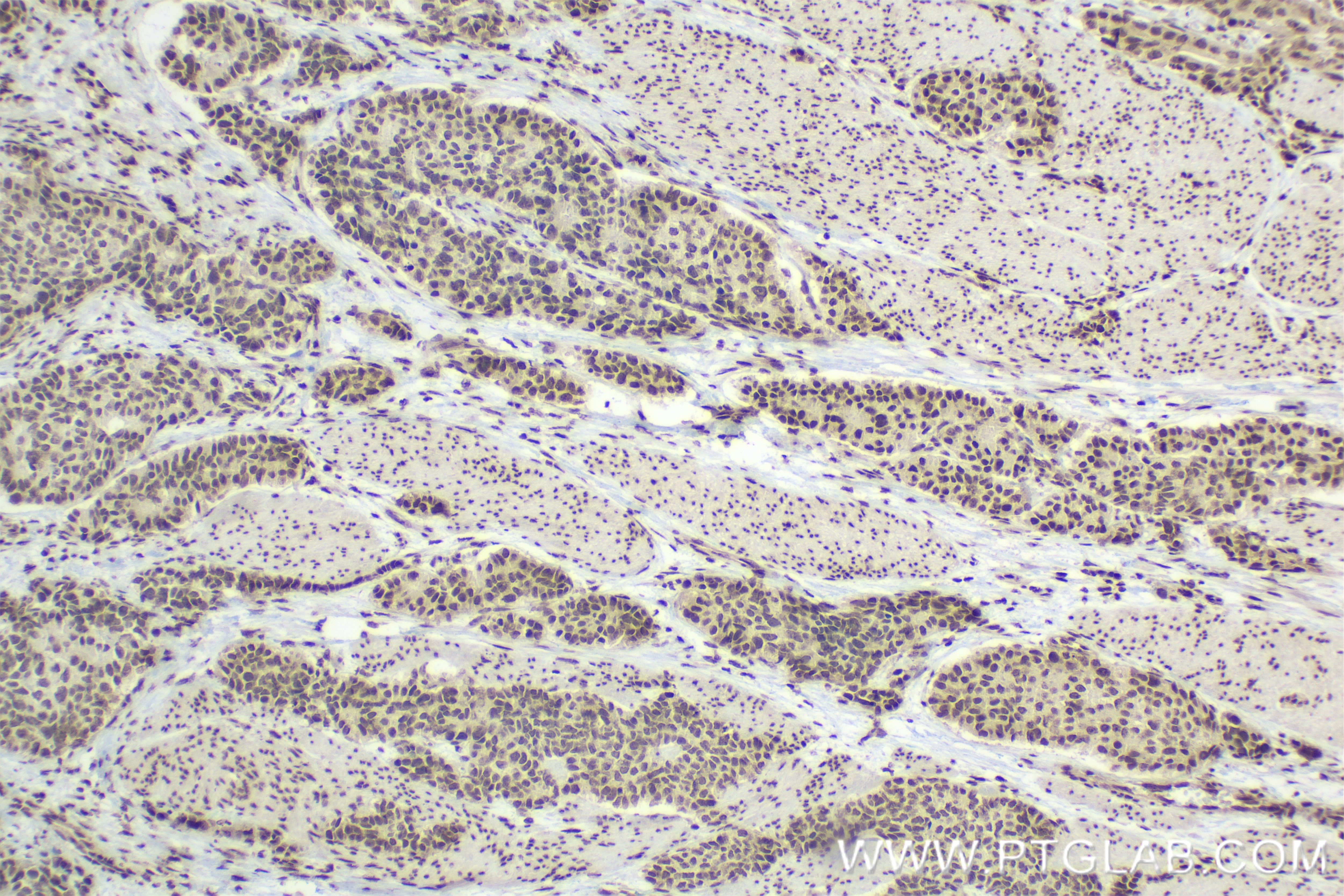 Immunohistochemistry (IHC) staining of human stomach cancer tissue using CDC25A Recombinant antibody (84145-2-RR)