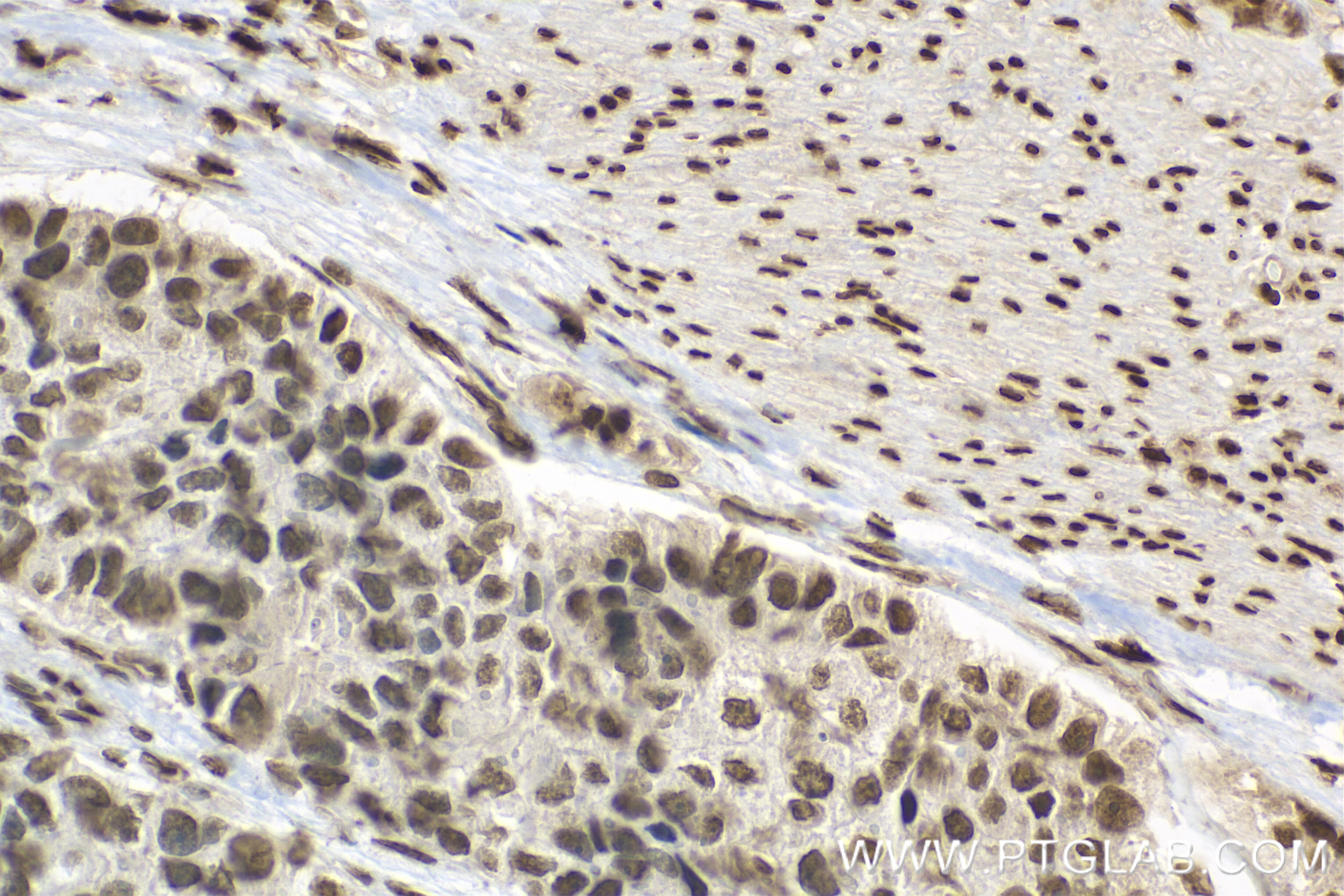 Immunohistochemistry (IHC) staining of human stomach cancer tissue using CDC25A Recombinant antibody (84145-2-RR)