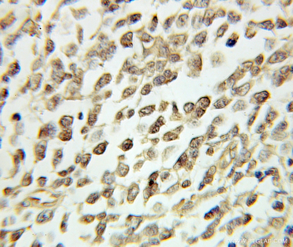 Immunohistochemistry (IHC) staining of human lymphoma tissue using CDC25B Polyclonal antibody (10644-1-AP)