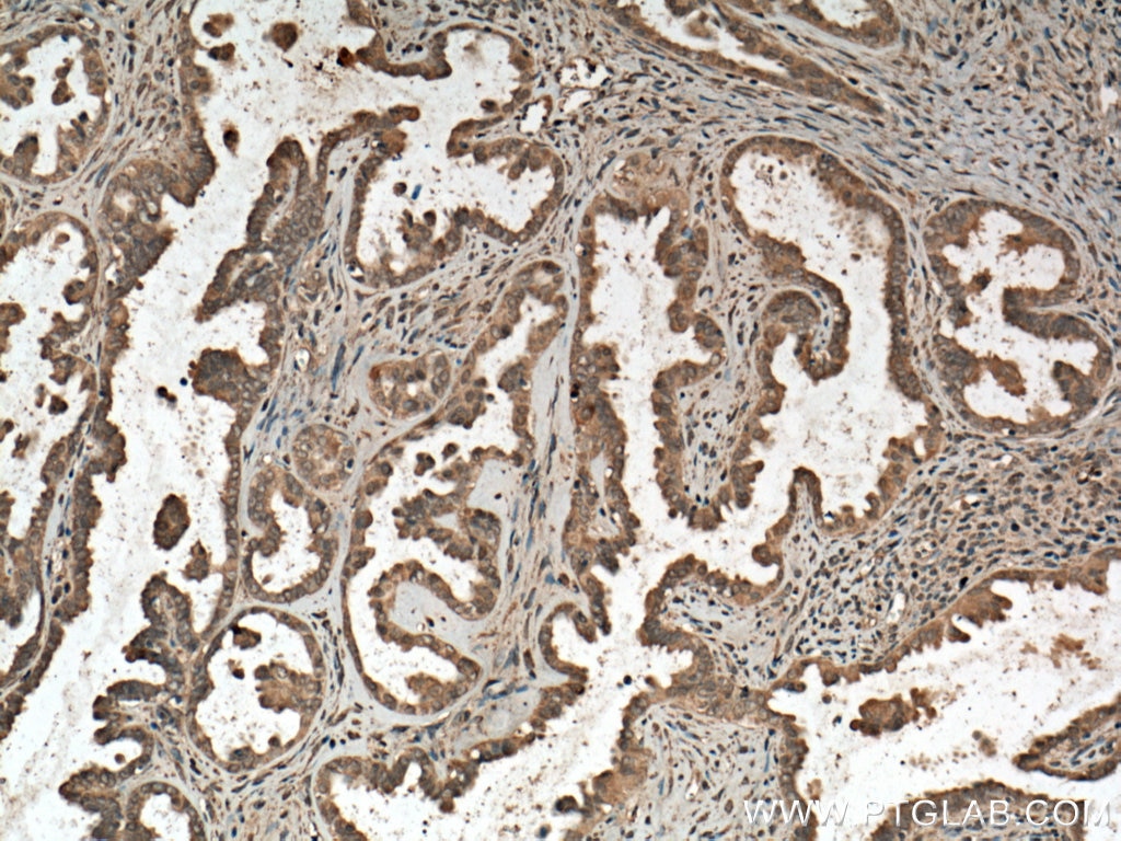 Immunohistochemistry (IHC) staining of human ovary tumor tissue using CDC25B Polyclonal antibody (28109-1-AP)