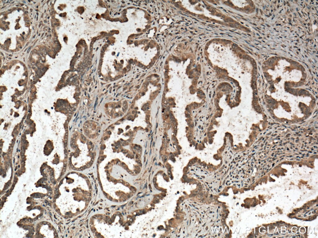 IHC staining of human ovary tumor using 28109-1-AP