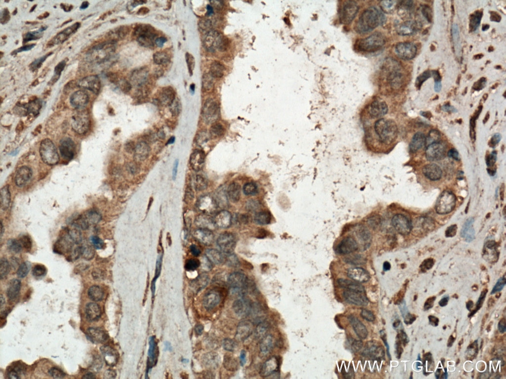 Immunohistochemistry (IHC) staining of human ovary tumor tissue using CDC25B Polyclonal antibody (28109-1-AP)