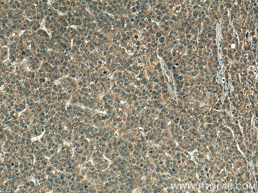 IHC staining of human liver cancer using 16485-1-AP