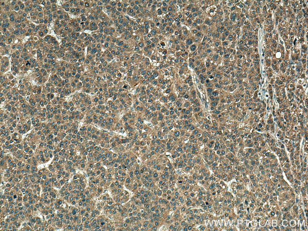 Immunohistochemistry (IHC) staining of human liver cancer tissue using CDC25C Polyclonal antibody (16485-1-AP)