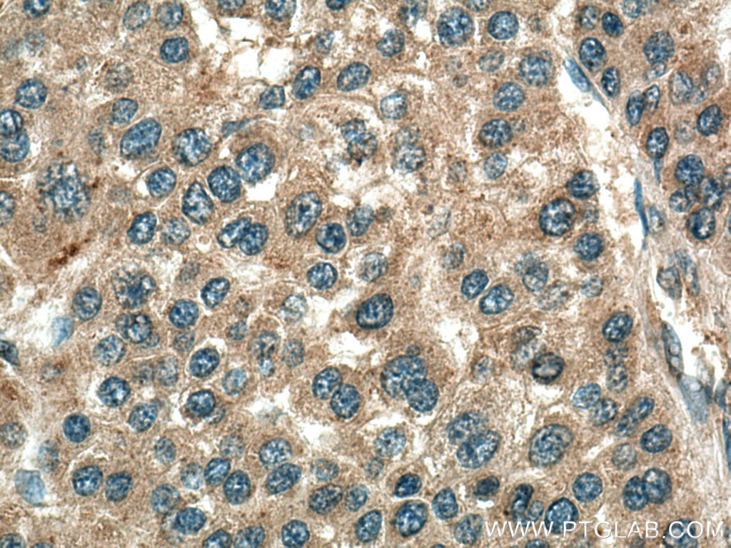 Immunohistochemistry (IHC) staining of human liver cancer tissue using CDC25C Polyclonal antibody (16485-1-AP)