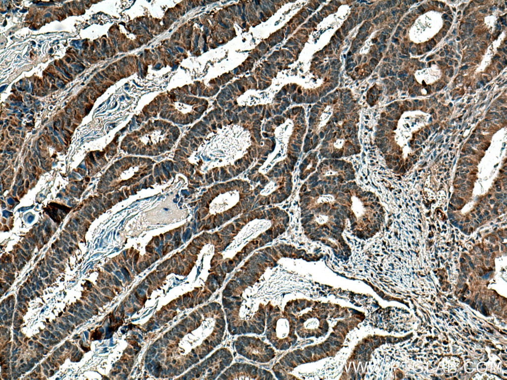 Immunohistochemistry (IHC) staining of human colon cancer tissue using CDC25C Polyclonal antibody (16485-1-AP)