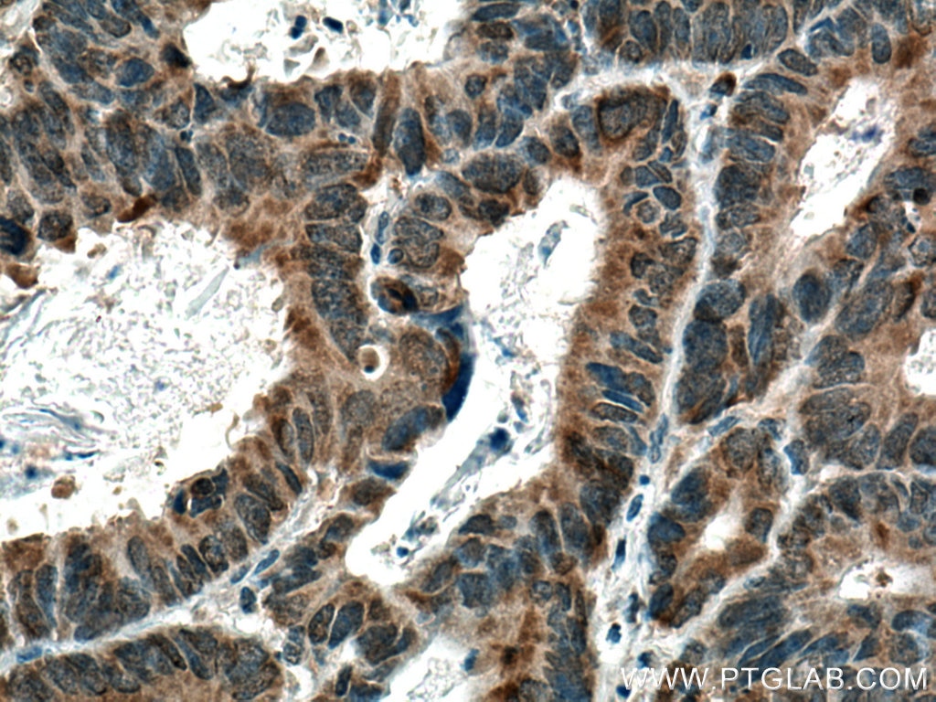 Immunohistochemistry (IHC) staining of human colon cancer tissue using CDC25C Polyclonal antibody (16485-1-AP)