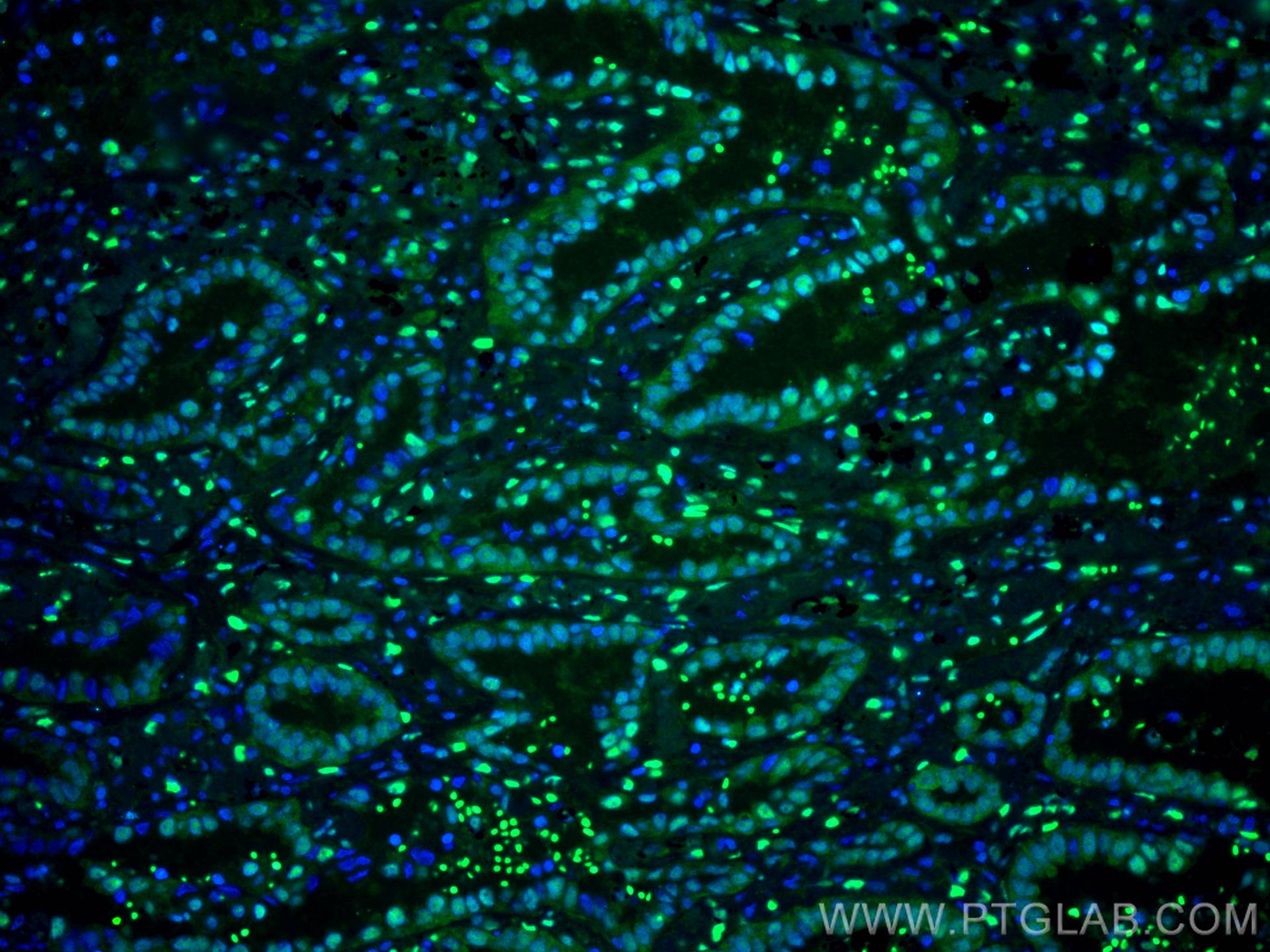 Immunofluorescence (IF) / fluorescent staining of human lung cancer tissue using CDC27; APC3 Monoclonal antibody (67239-1-Ig)