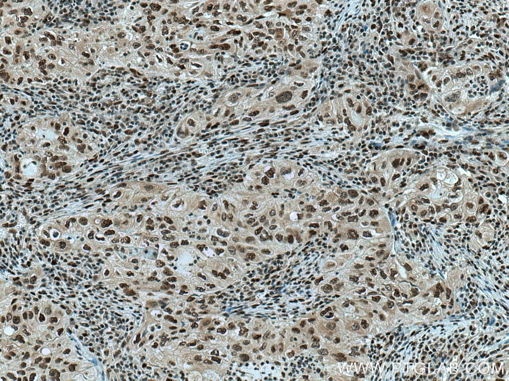 Immunohistochemistry (IHC) staining of human lung cancer tissue using CDC27; APC3 Monoclonal antibody (67239-1-Ig)