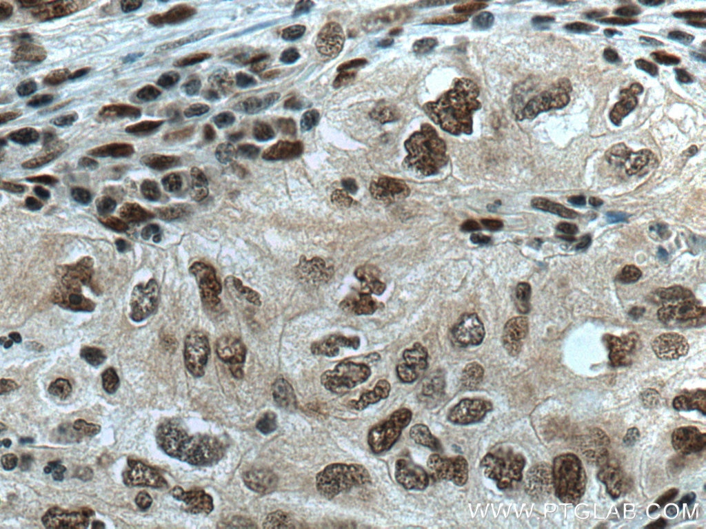 Immunohistochemistry (IHC) staining of human lung cancer tissue using CDC27; APC3 Monoclonal antibody (67239-1-Ig)