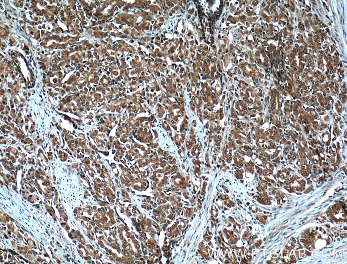 Immunohistochemistry (IHC) staining of human prostate cancer tissue using CDC27; APC3 Polyclonal antibody (10918-1-AP)